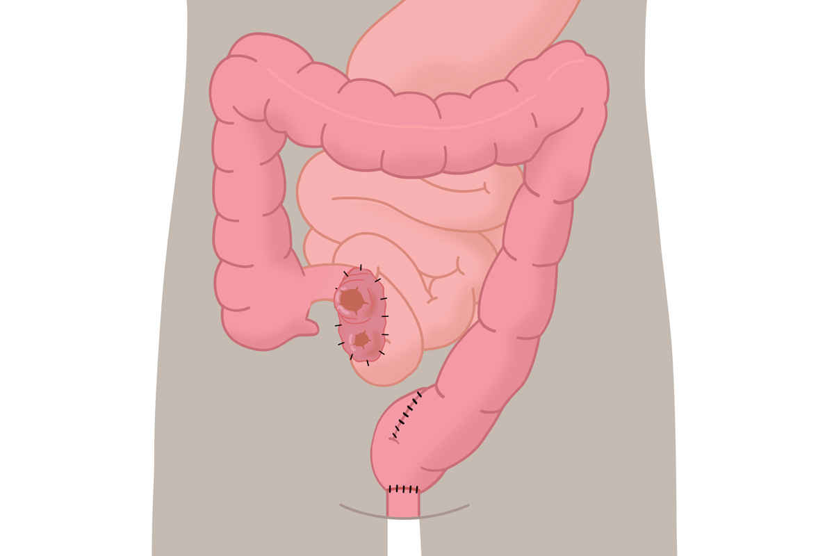 Graphische Darstellung: Das doppelläufige Ileostoma als meist temporäre Form eines Anus praeter