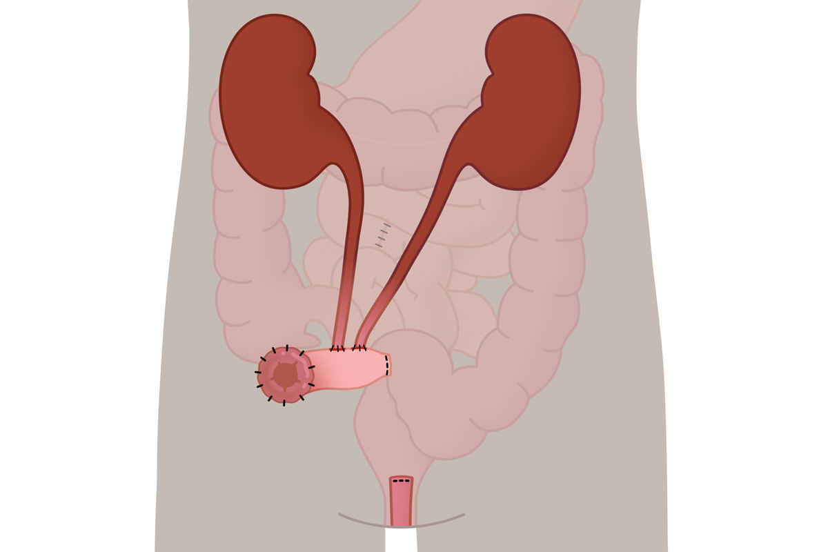 Graphische Darstellung eines Ileum Conduit als Variante für einen künstlichen Blasenausgang