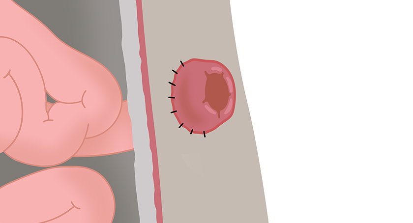 Graphische Darstellung eines Stoma